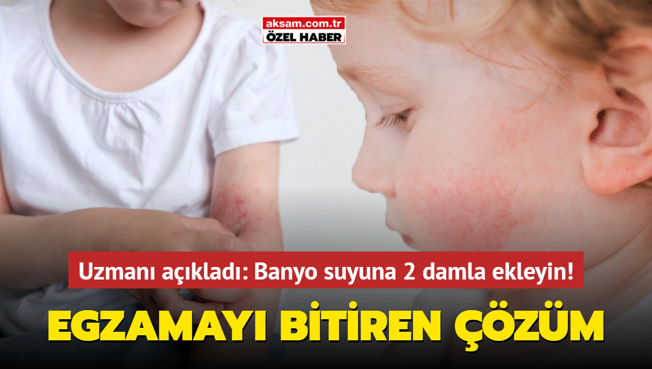 Egzamayı yok eden banyo suyuna 2 damla ekleyin! Uzmanlardan etkili çözüm önerisi.